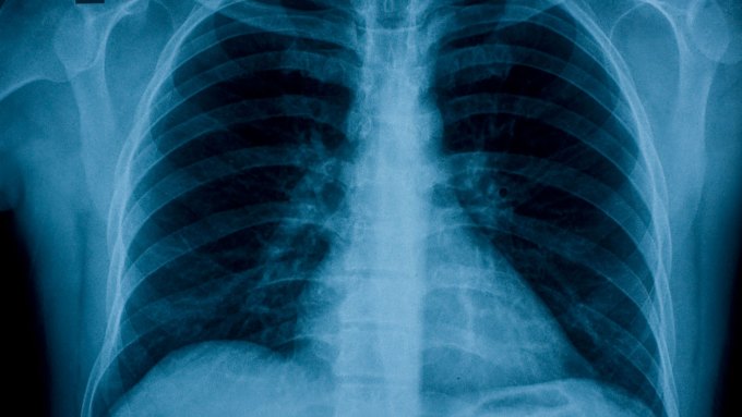 An X-ray image of the chest, shown in shades of white, blue and black. AI models can scan these medical images and reveal health information.