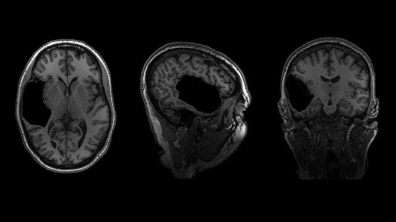 Three views of a brain scan from different angles showing a big black spot in a woman's brain.